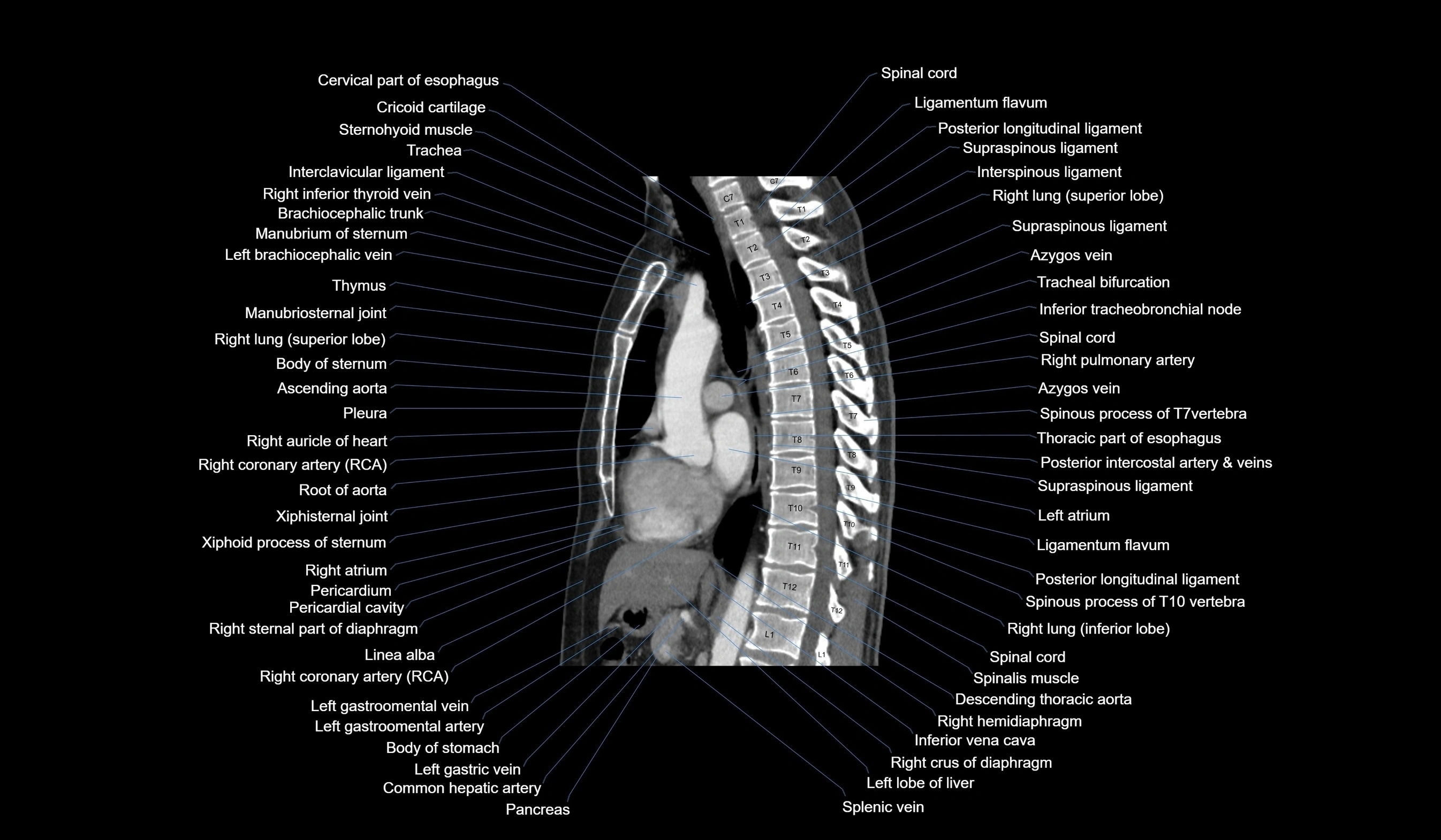 CT chest (thorax) soft tissue window labelled sagittal cross sectional anatomy radiology image-00073.webp